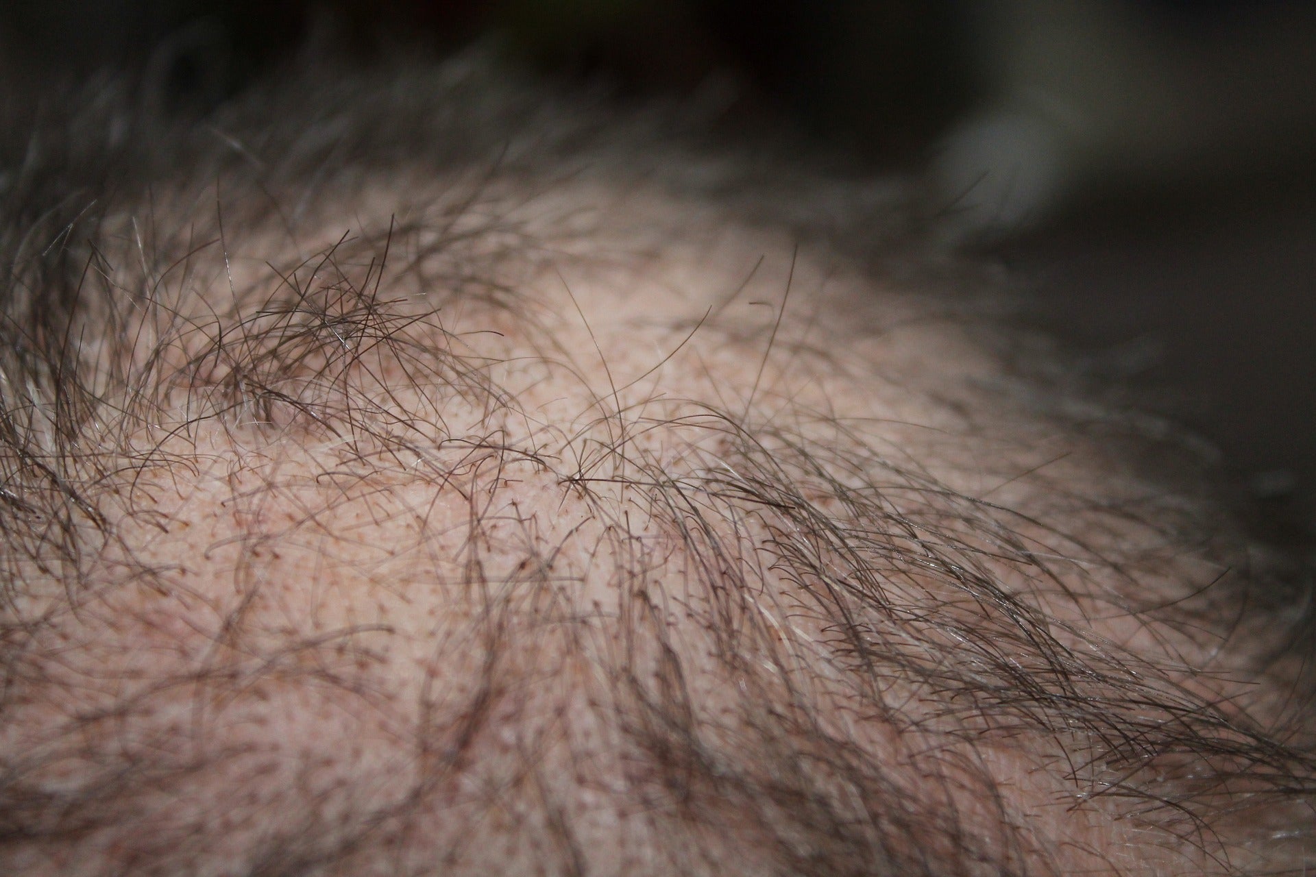 Cause della caduta dei capelli: cosa fare